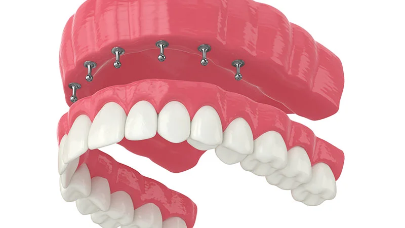 Çıtçıtlı İmplant Nedir, Nasıl Uygulanır
