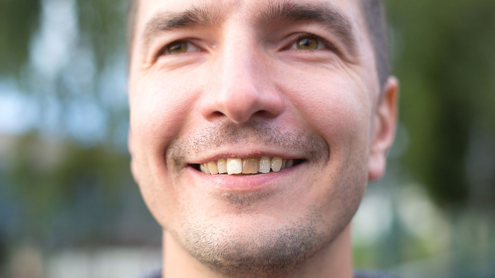 Diş beyazlatma yöntemleri öncesi dişlerinde sararma bulunan hasta fotoğrafı