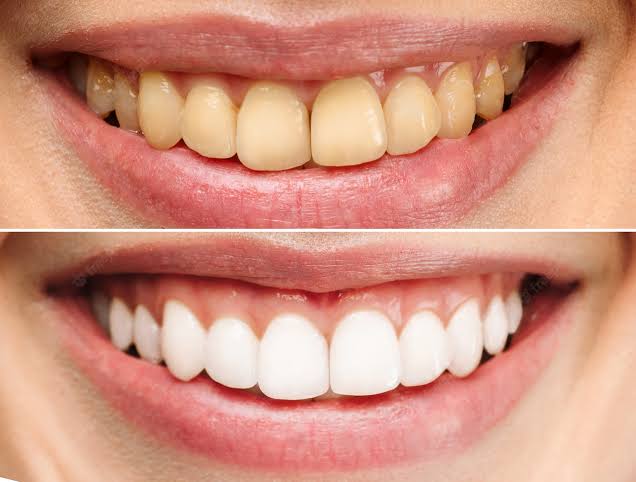Diş Taşı Temizliği Sonrası Nelere Dikkat Edilmelidiri