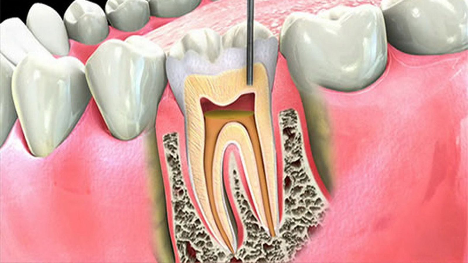 Endodonti Nedir Hangi Durumlarda ve Nasıl Yapılır