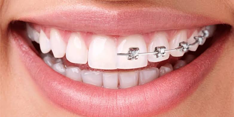 Ortodonti Nedir Hangi Diş Problemleriyle İlgilenir