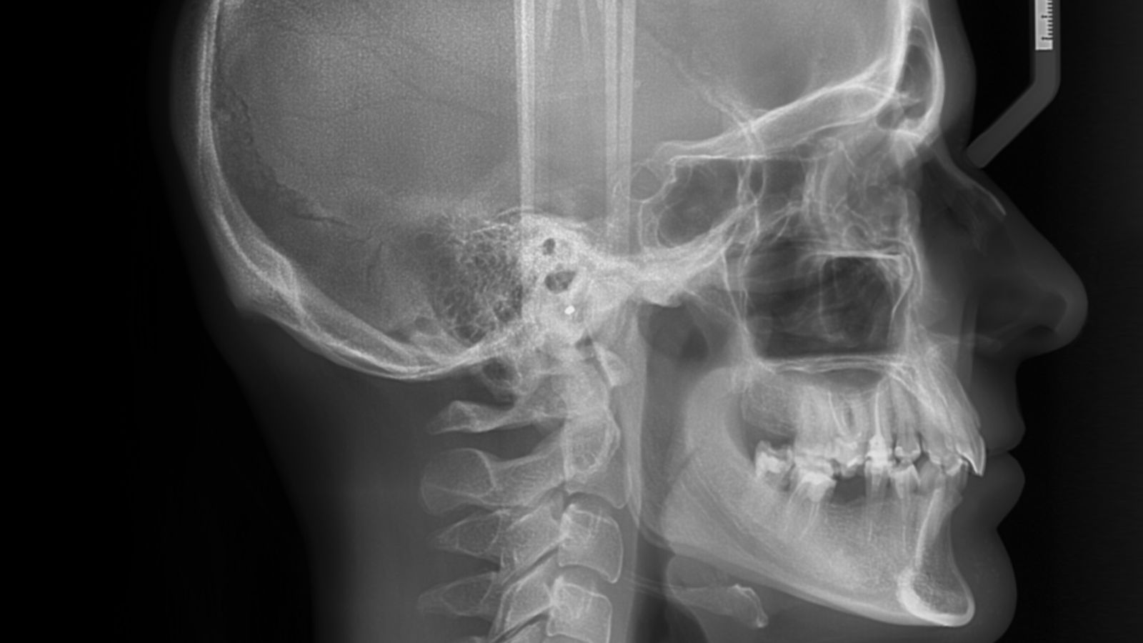 Sefalometrik röntgen görüntüsü – kafa ve çene kemik yapısının detaylı yan profil röntgeni