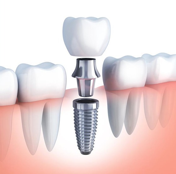 İzmir implant görseli