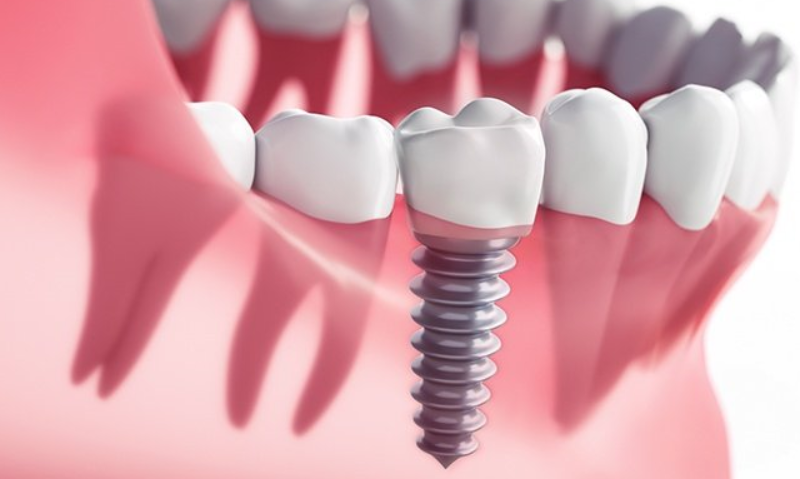implant omru ne kadardir