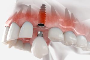 İzmir all-on-four implant and izmir all-on-six implant